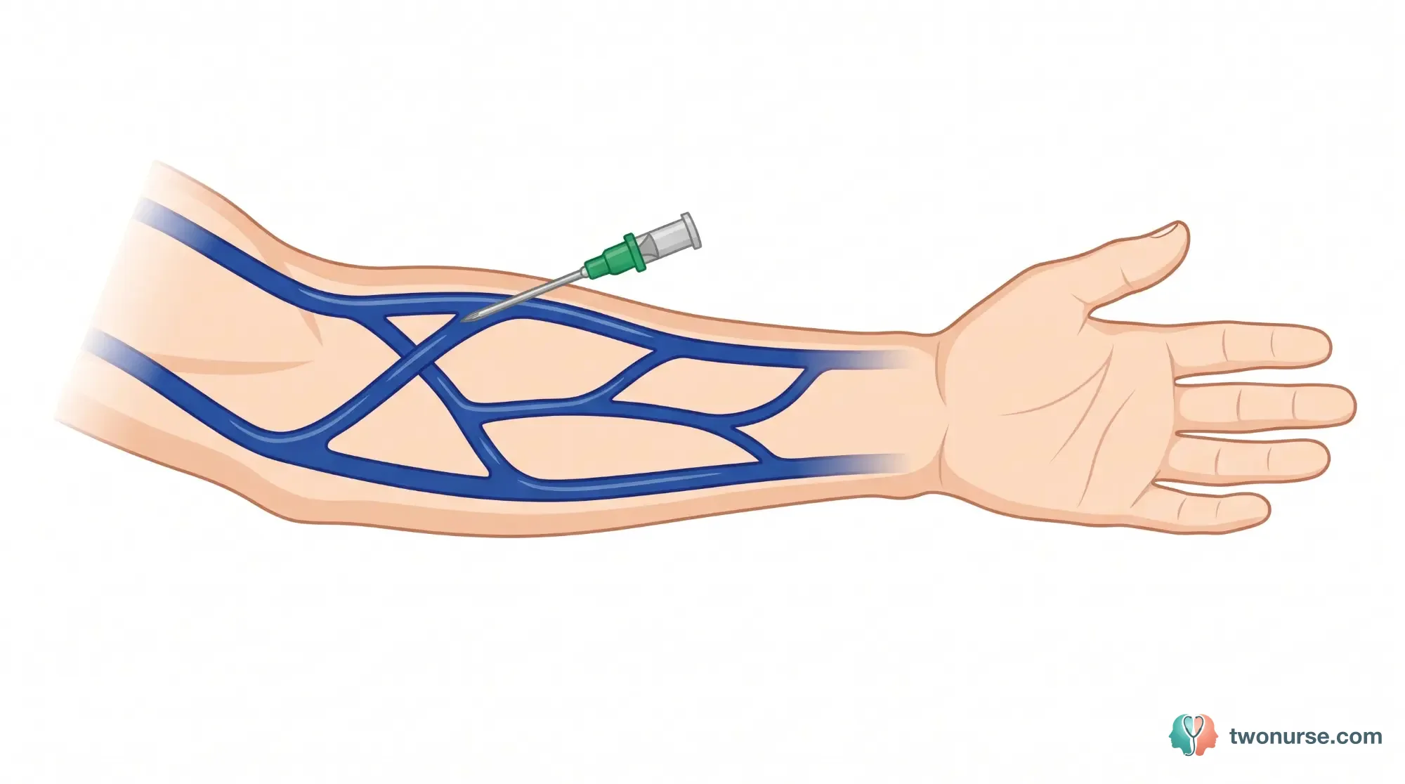 Illustrazione anatomica dell'incannulamento venoso periferico: vena cefalica, basilica e mediana cubitale con catetere 18G in inserimento